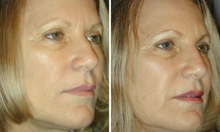 Before and After 5 Minute Injectable Nose Job
