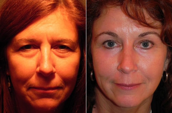 Before and After Minimal Incision Brow Lift and Lower Eyelid Surgery