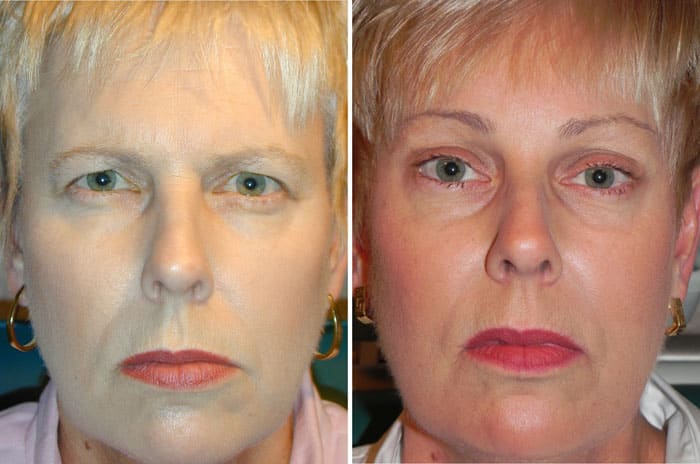 Before and After Minimal Incision Browlift