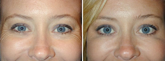 Before and After Crows Feet Treatment with Botox