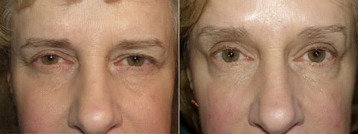 Before and After Browlift Treatment with Botox