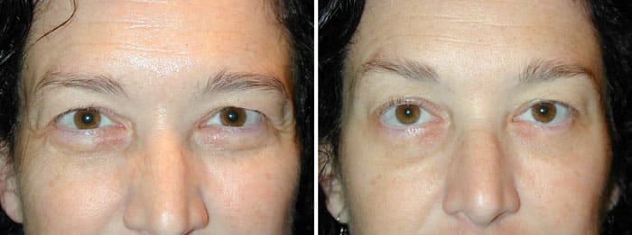 Before and After Browlift Treatment with Botox