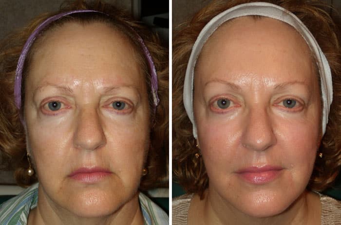 Before and After RadiantLift