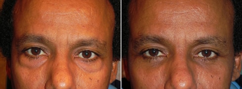 Before and after using fillers to treat fat shifts in the lower eyelid area.