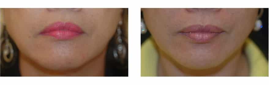 Downturned Lips Treatment 9400