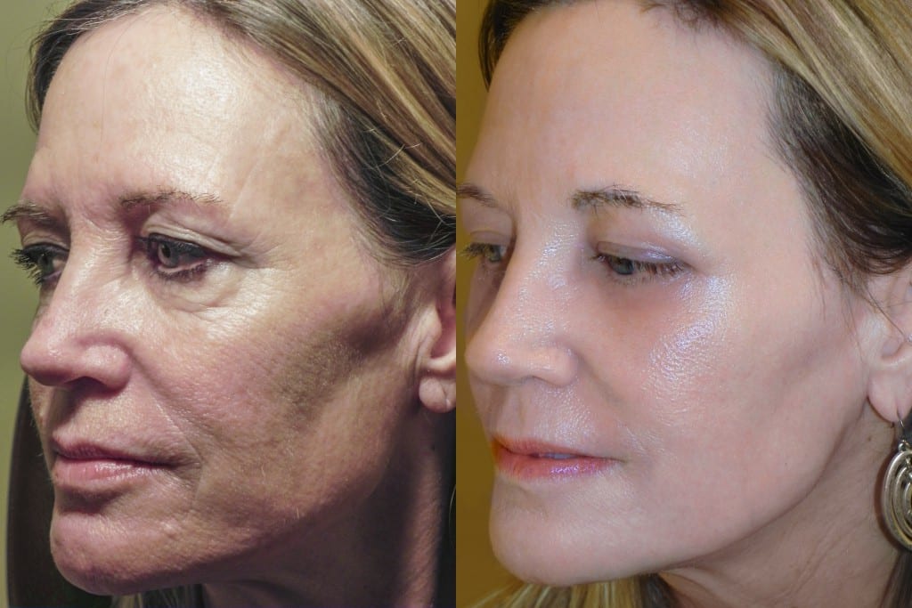 Before and after RESET for sun damage procedure