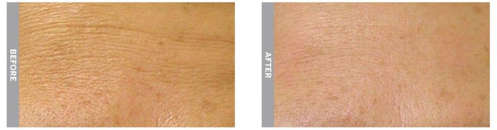 HydraFacial treatment for fine lines (before and 1-month after treatment)