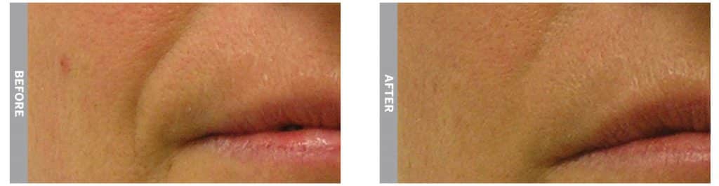 HydraFacial treatment for laugh lines (before and after 5 sessions)