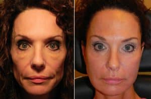 lower lid blepharoplasty results