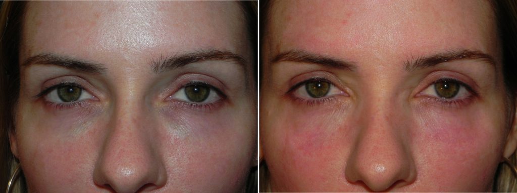 under eye fillers and Tyndall Effect