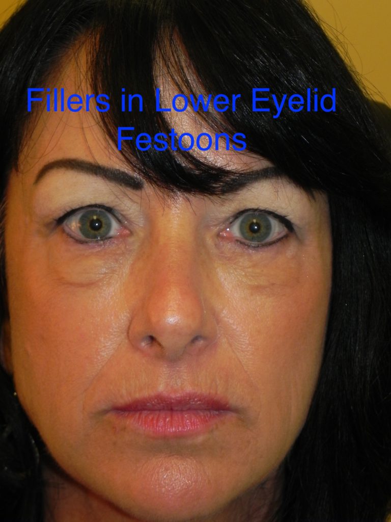 under eye fillers and festoons and malar mounds 