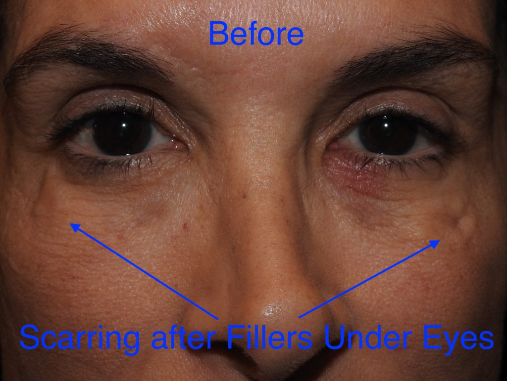 under eye filler before and after