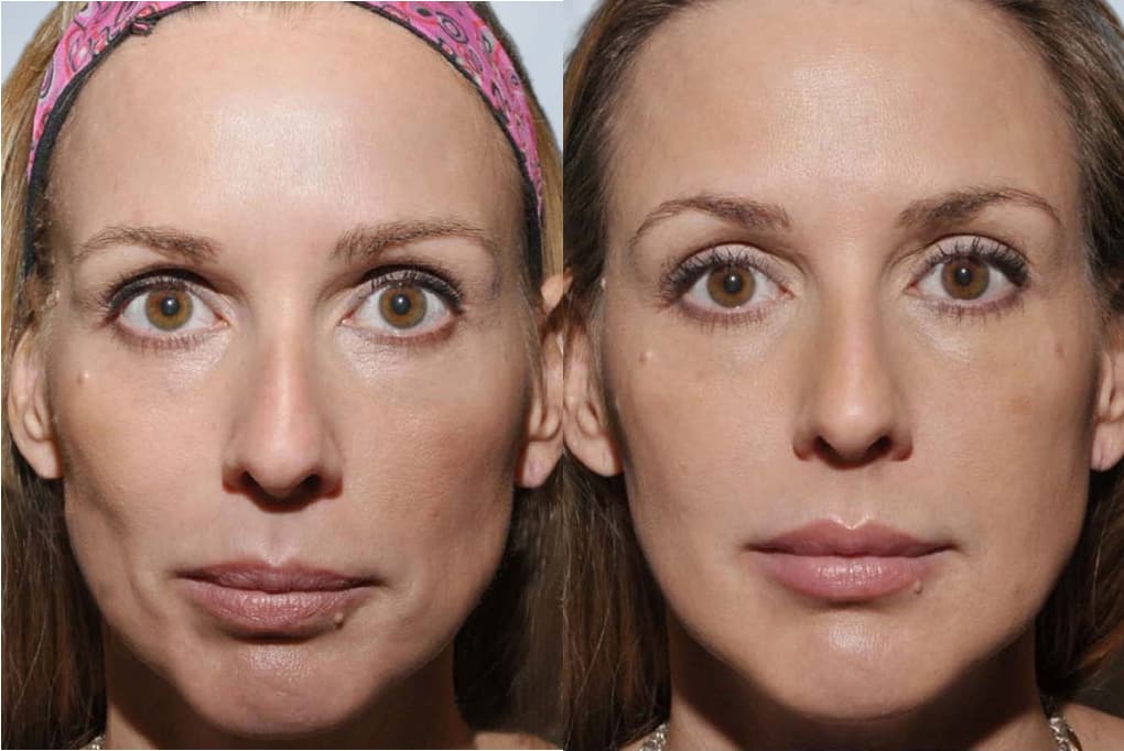 Sculptra Before and After treatment images
