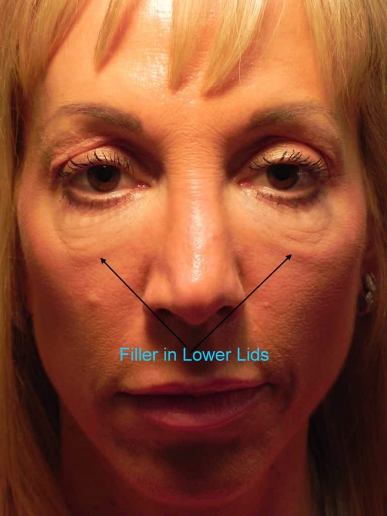 Dr. Scheiner dissolves fillers under the eyes for patient before 