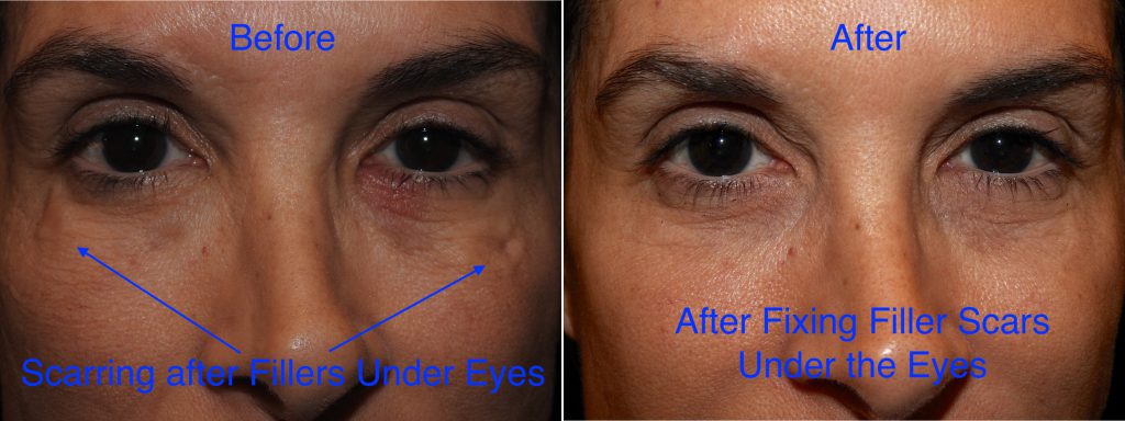 problems with fillers under the eyes 